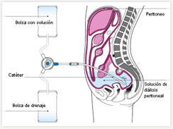 Diálisis peritoneal manual